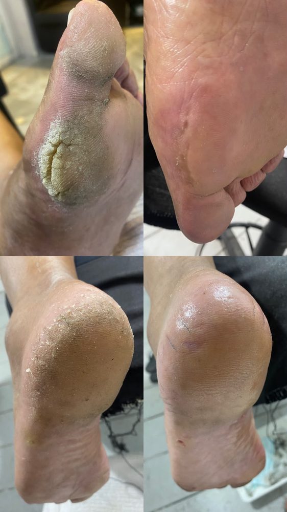 Podologia preventiva