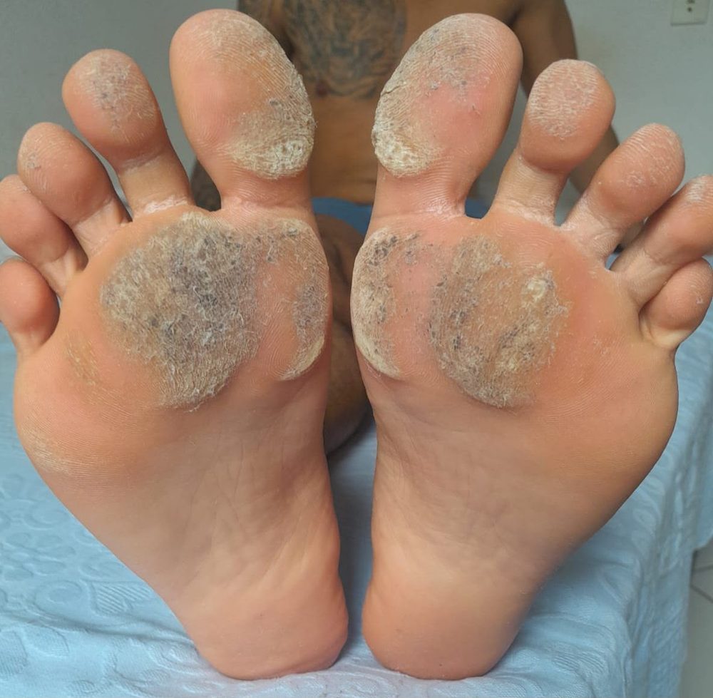 Podoprofilaxia