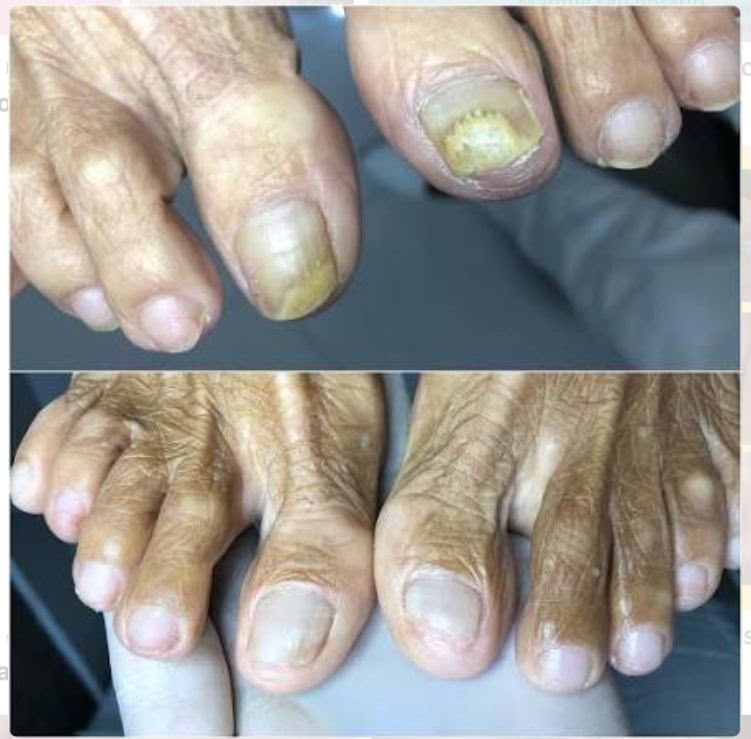 Tratamento de micose